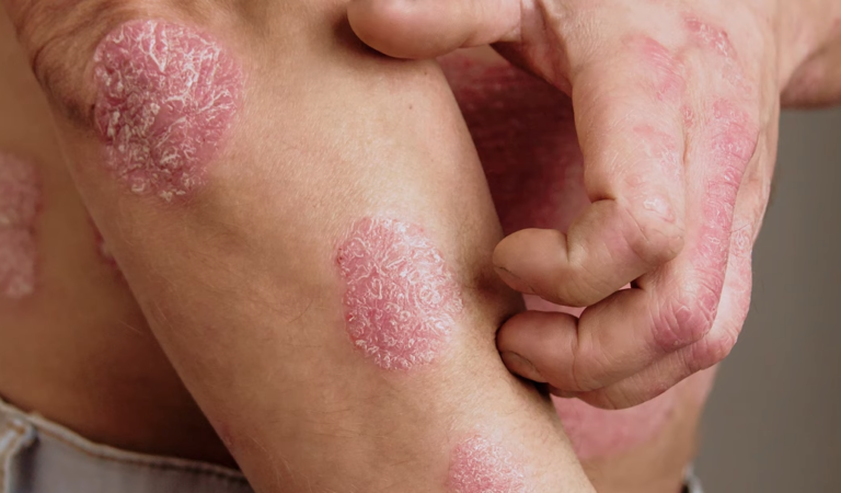 Psoriasis Treatments and Skin Disorders Fast Facts